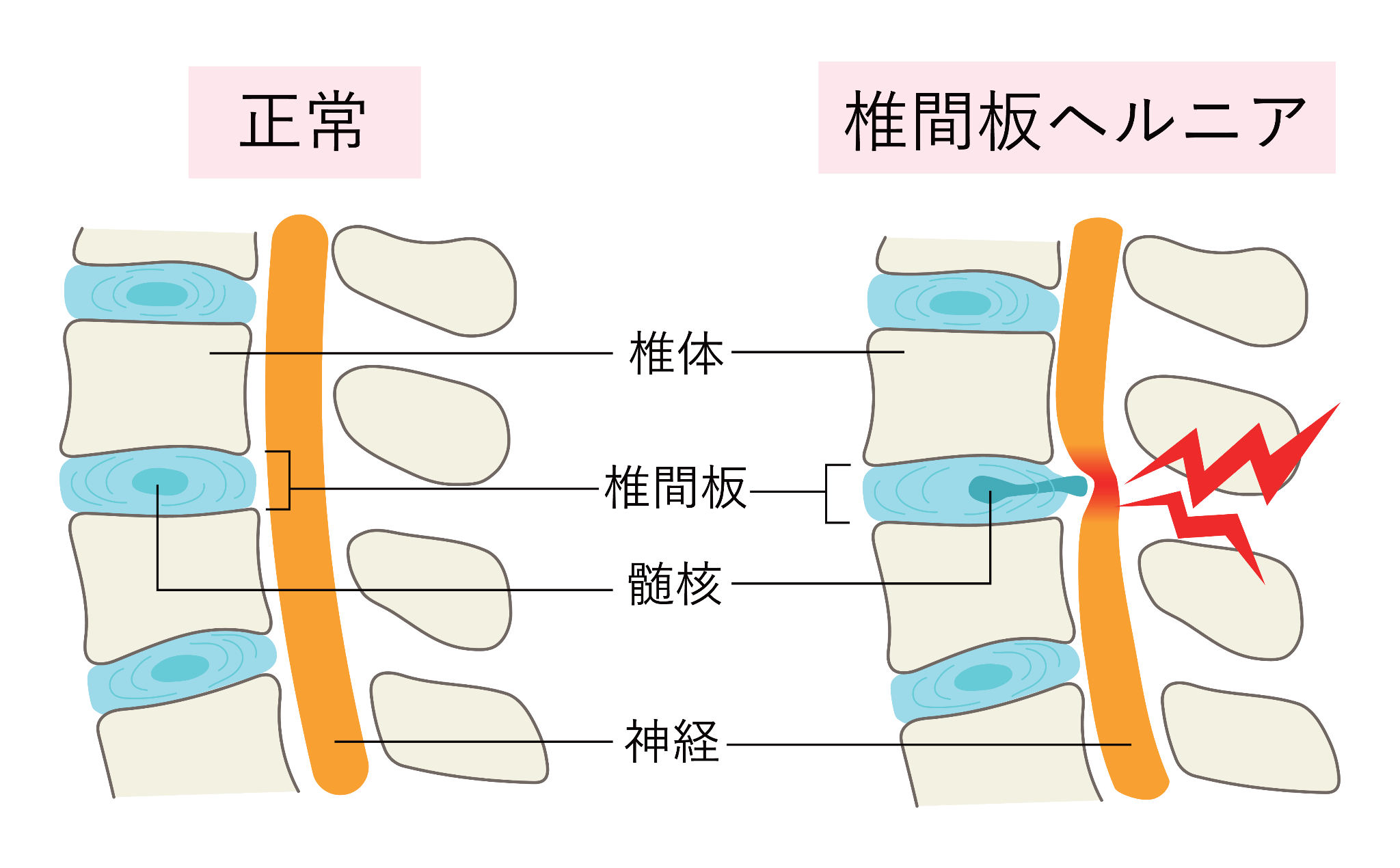 椎間板ヘルニア比較